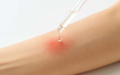 Think twice: can skin products burn your skin and how to protect yourself